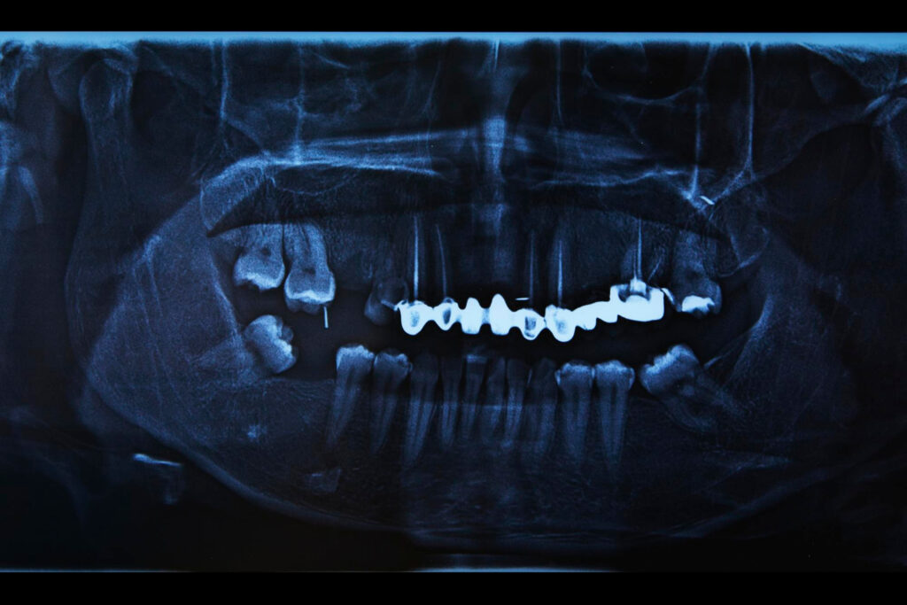 Human teeth x-ray